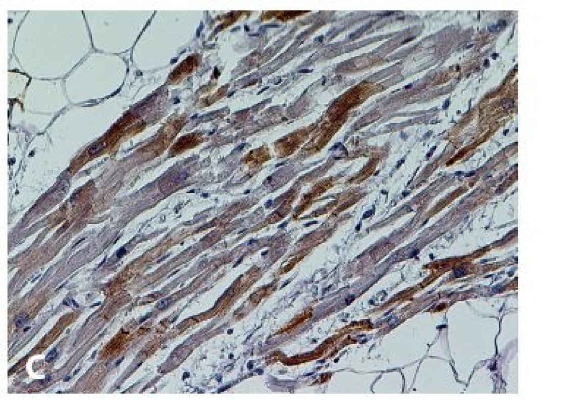 Příklady imunohistochemického vyšetření myokardiálních markerů s prokázaným či možným vlivem v patogenezi a diagnostice arytmogenní ventrikulární kardiomyopatie. 