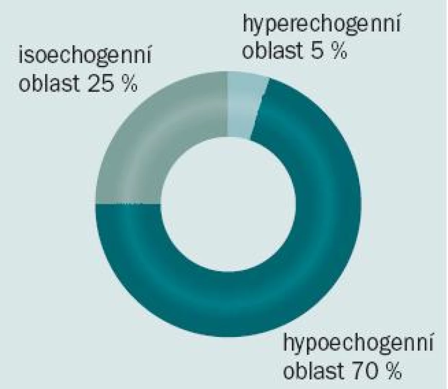 Ultrazvukové zobrazení karcinomu prostaty.