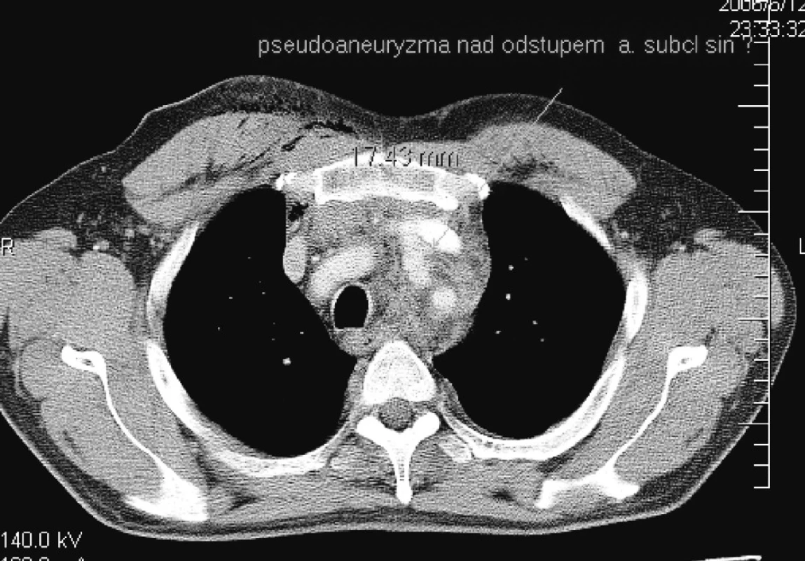 CT nález – Pseudoaneuryzma pri neúplnej lézii steny ľavej karotickej tepny
Pic. 3. CT finding – A pseudoaneurysm in incomplete lesion of the right carotid arterial wall