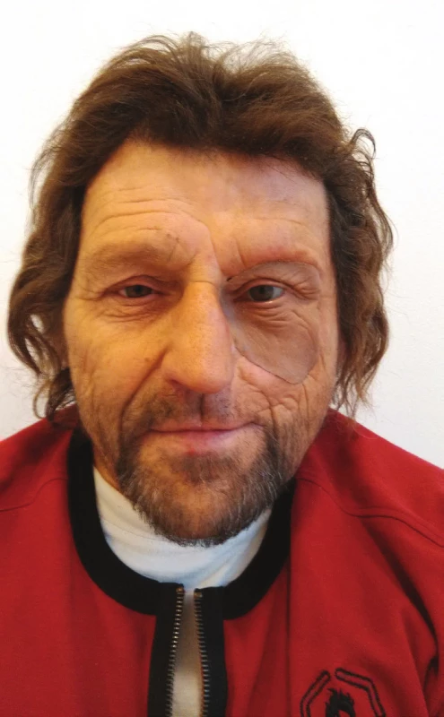 Pacient s nasazenou epitézou