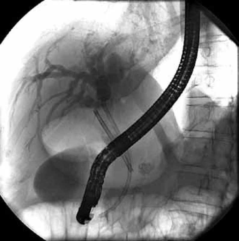 Rovnaký nález ako na predchádzajúcom obrázku, naviac však zavedený nový 10 Fr 12 cm dlhý plastový stent.
Fig. 2. The same observation as on previous picture, but new inserted 10 Fr 12 cm long plastic stent.