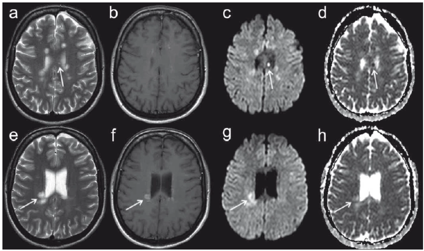 MR vyšetření pacientky ve věku 39 let s přibližně 8denní anamnézou parestezií končetin.
Fig. 5. MRI examination in a 39-year-old female patient with approximately eight-day history of limb paraesthesia.