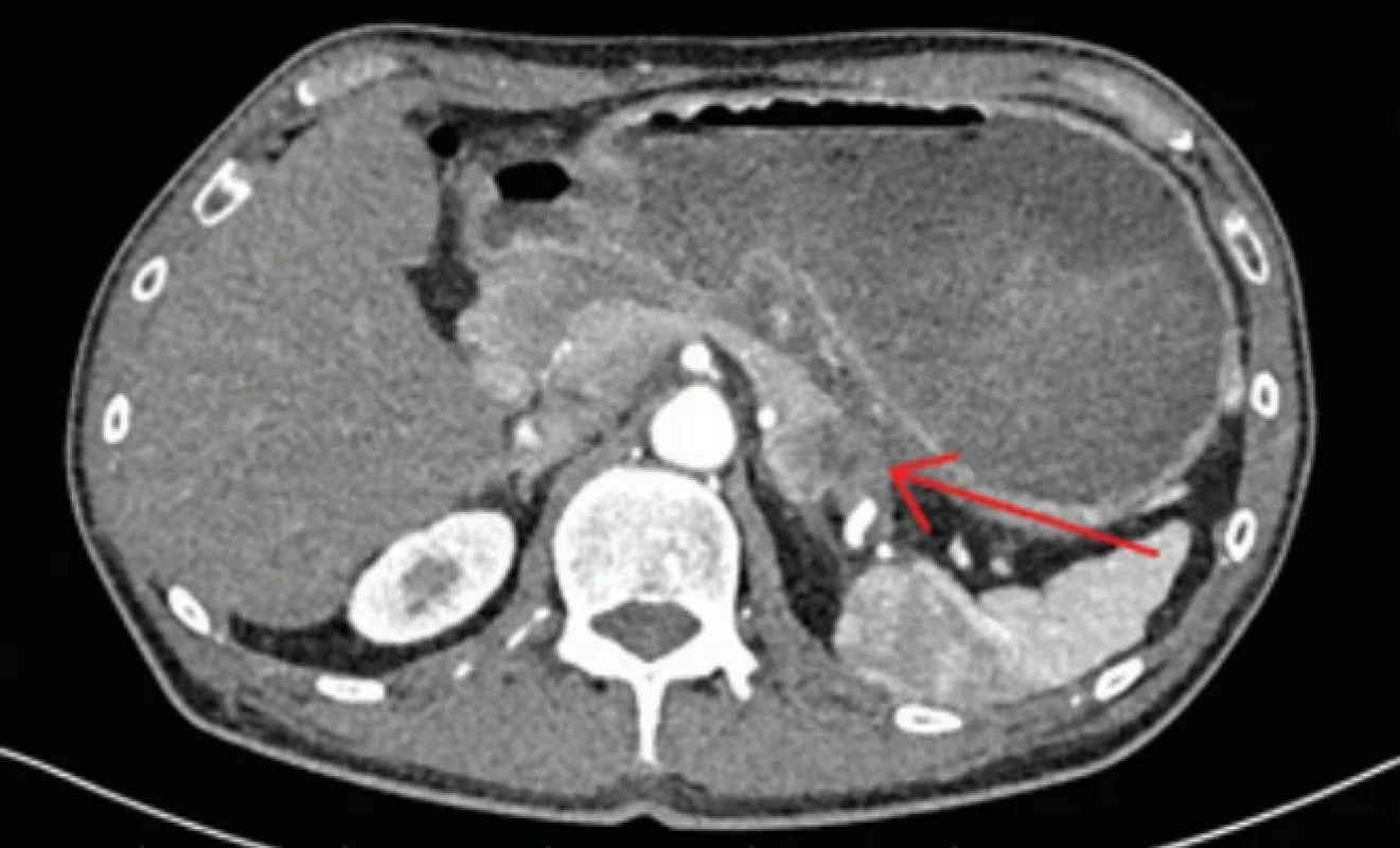 CT nález tumoru chvosta pankreasu v transverzálnej rovine, arteriálna fáza (tumor vyznačený červenou šípkou). Fig. 2. CT finding of a tumor in the tail of the pancreas in the transverse plane, arterial phase (tumor indicated by a red arrow).