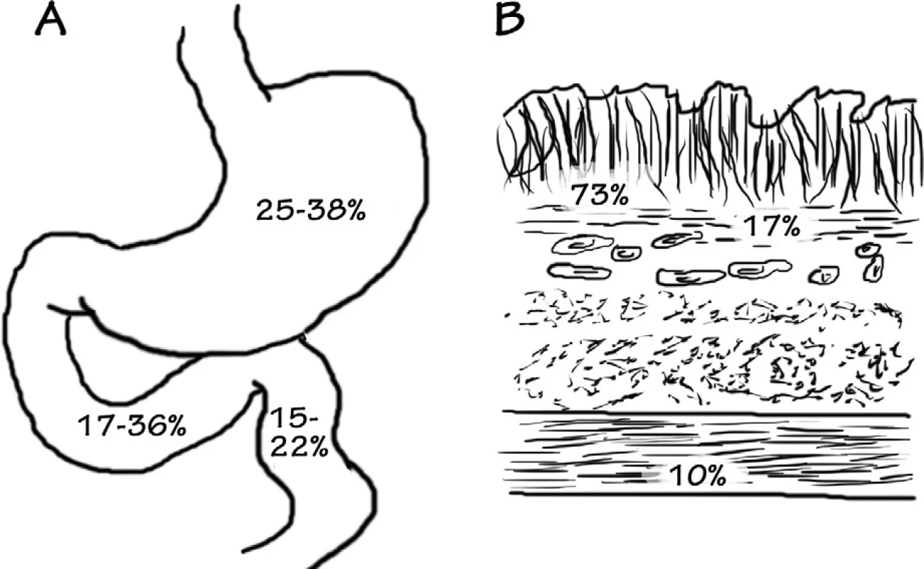Najčastejšia lokalizácia heterotopického pankreasu (A – anatomická lokalizácia – 25–38 % žalúdok, 17–36 % duodenum, 15–22 % jejunum; B – histologická lokalizácia – 73 % submukózne, 17 % – lamina muscularis propria, 10 % – subserózne) – podľa [9]
Obr. 1. The most common localization of heterotopic pancreas (A – anatomical localization – 25–38% stomach, 17–36% duodenum, 15–22% jejunum, B – histological localization – 73% submucous, 17% – lamina muscularis propria, 10% – subserous) – according to [9]