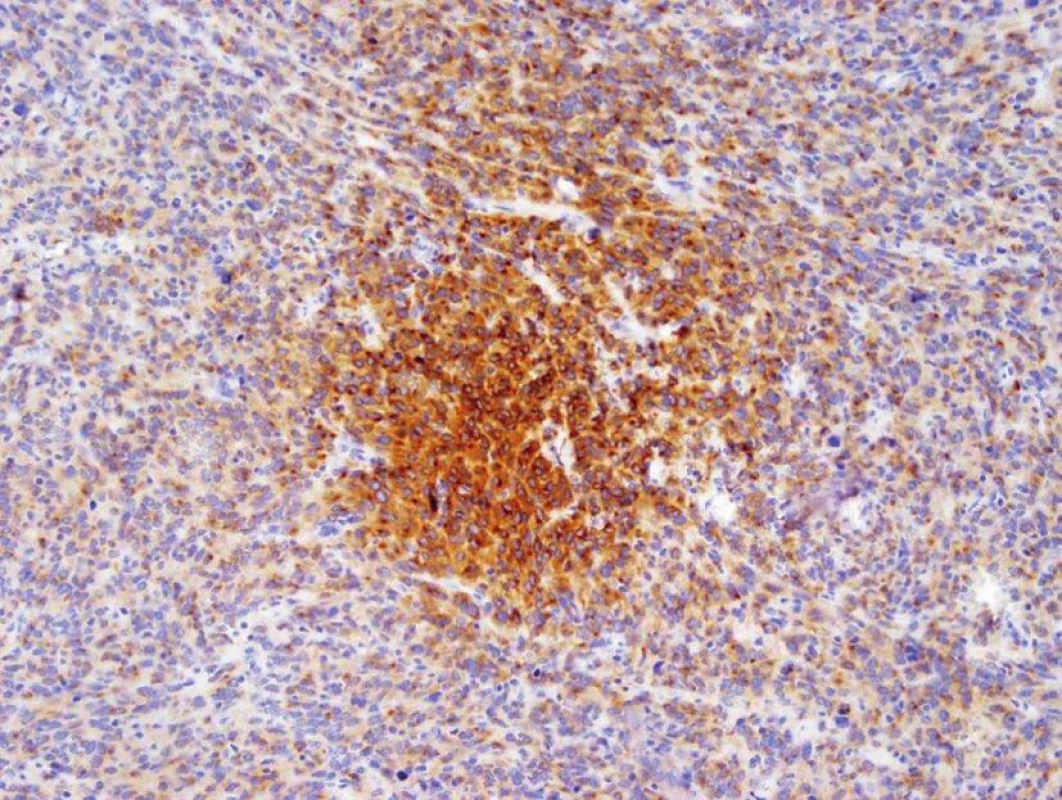 Recidiva tumoru − imunohistochemické vyšetření protilátkou CD117 – pozitivita (hnědé zbarvení) je jednoznačné kritérium diagnózy GIST
Fig. 10: Tumor reccurence − CD117 antibody immunohistochemistry − positivity (brown staining) is an unambiguous criterion for the diagnosis of GIST