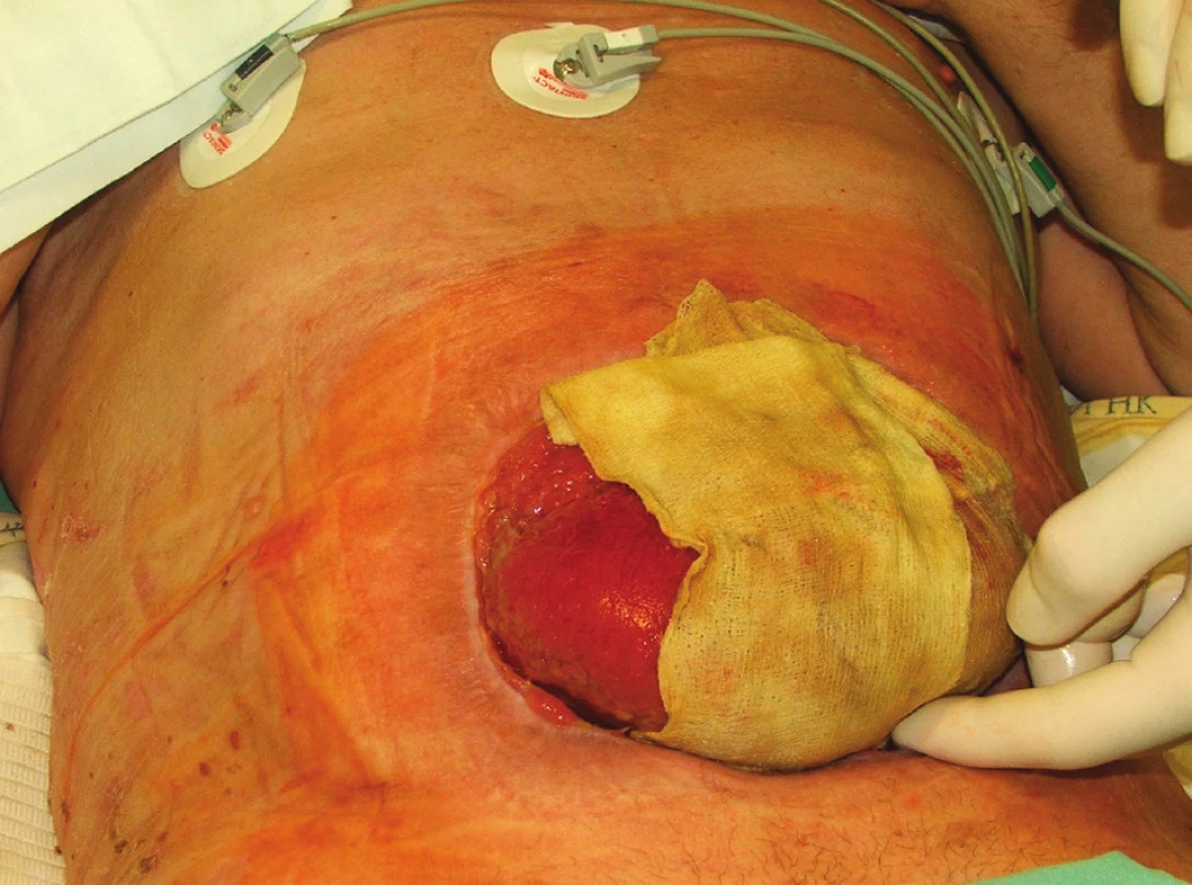 Situace 2 týdny po rekonstrukční operaci GIT s ponechaným laparostomatem (pacient č. 9)
Fig. 4 The same patient 2 weeks after his GIT reconstruction procedure with laparostomy (patient No 9)