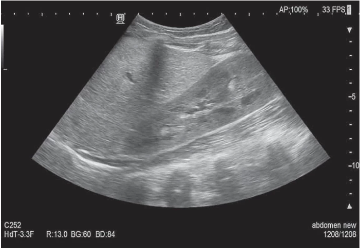 Ultrasonografické vyšetrenie – hepatomegália (v pozdĺžnom reze 13,1 cm), pa- renchým nehomogénny echogénnejší s nepravidelnými líniami a viacerými cystickými útvarmi (4–5 mm). Zväčšená pravá oblička (12,4 × 5 cm), parenchým echogénnejší s via- cerými cystickými útvarmi do 5 mm. // Fig. 1. Ultrasonographic examination – liver enlarged (13.1 cm), inhomogeneous, more echogenic parenchyma with echogenic irregular lines, cystoid formations (4–5 mm). Right kidney (12.4 × 5 cm), more echogenic parenchyma, microcysts (5 mm). 