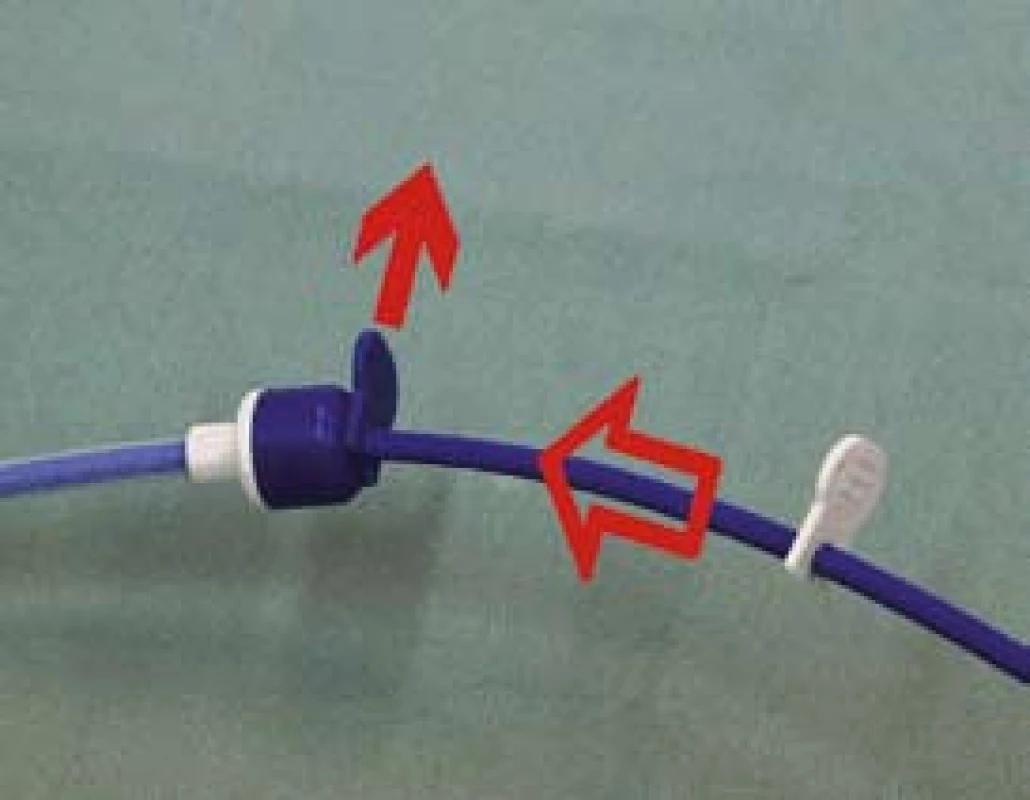 Odjištění první zarážky na zavaděči stentu a rozevření stentu v první poloze umožňující insuflaci balonku a fixaci stentu.
Fig. 4. Unlocking the first stop in the stent applicator and opening stent in the first position, enabling balloon insufflation and stent fixation.
