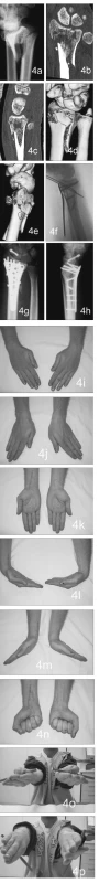 Zlomenina distálního radia typu C.3. (a, b, c, d, e), osteosyntéza rekonstrukční dlahou systému Aptus radius, na peroperačním snímku znázorněna operační technika – zjednodušení zlomeniny tahovými šrouby, dočasná stabilizace Kirschnerovými dráty, ukotvení dlahy do distálních fragmentů a obnovení volárního sklonu kloubní plochy přiklopením dlahy k proximálním fragmentům (f), kostní hojení po 8 týdnech (g, h), funkční výsledky (i, j, k, l, m, n, o, p); současná
zlomenina os scaphoideum ošetřena HBS šroubem
Fig. 4. The distal radius fracture, type C.3. (a, b, c, d, e), osteosynthesis with Aptus radius reconstruction plate. The preoperative view depicts the surgical technique- simplification of the fracture with a traction screw, temporary stabilisation using the Kirschner wires, anchoring of the plate to the distal fragments and recovering the palmar tilt of the articular surface when the plate is pressed against the proximal fragments (f), the bone healing at 8 weeks (g, h), functional results (i, j, k, l, m, n, o, p); the co-existing fracture of the scaphoid is managed using the HBS screw