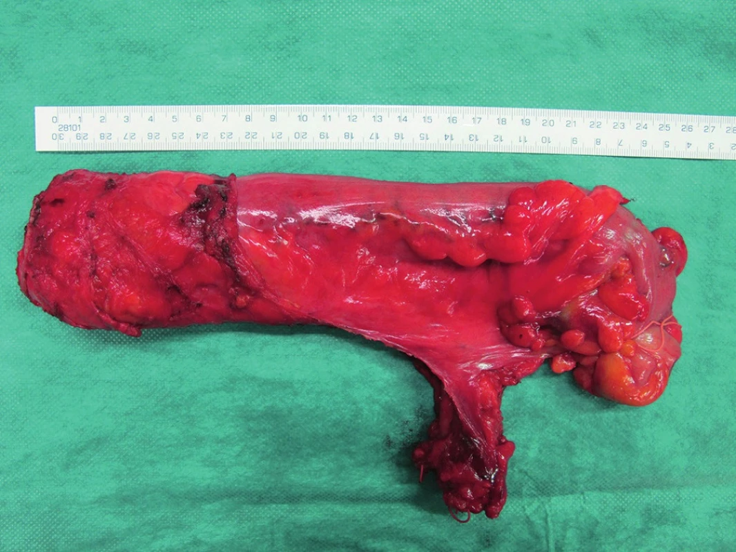 Roboticky asistovaná resekce rekta s kompletní parciální mezorektální excizí (PME) – fotografie resekátu
Fig. 4. Robotic assisted low anterior resection for rectal cancer with complete partial mesorectal excision (PME) – photography of resected specimen