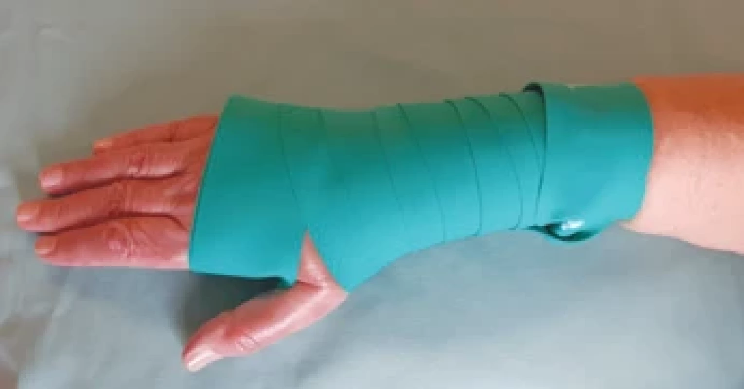 Aplikace fl ossingu na oblast zápěstí. </br>Fig. 6. Flossband application on the wrist area.