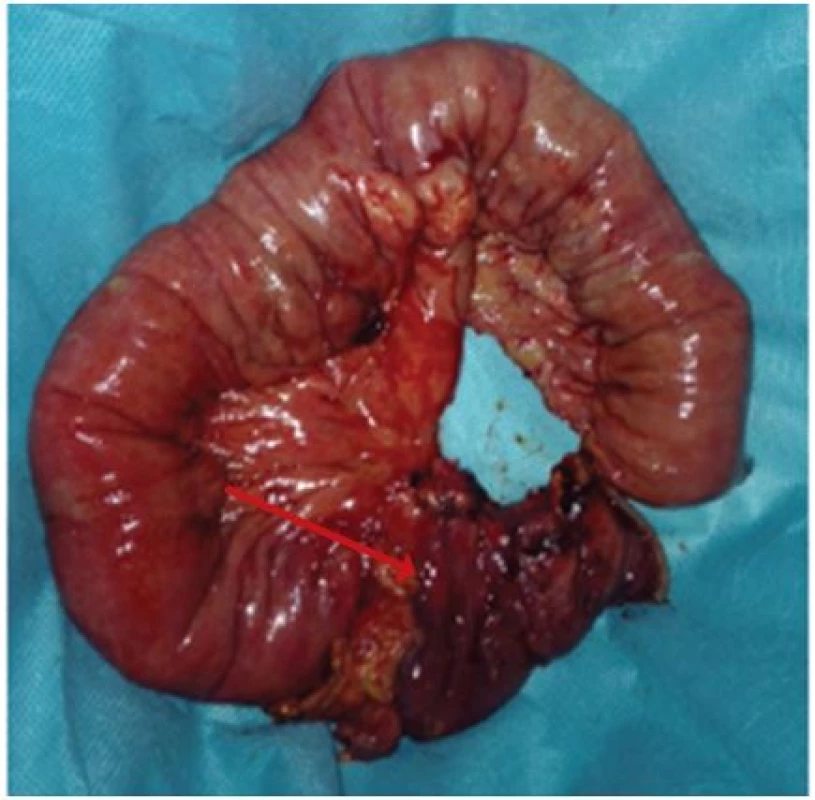 Peroperačný nález perforácie divertikla a ďalších divertiklov jejuna – vlastný materiál
Fig. 2: Intraoperative finding of perforated jejunal diverticulitis – our own material