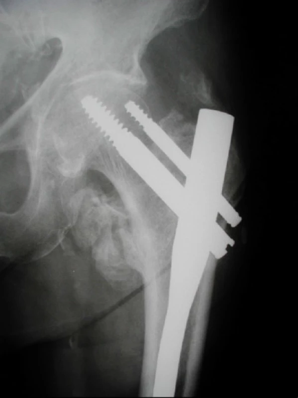 Pacientka, 65 let, s nestabilní pertrochanterickou zlomeninou, 12 týdnů po osteosyntéze. Nedostatečně zavedený hřeb s proříznutím závitu antirotačního šroubu při jeho zavedení