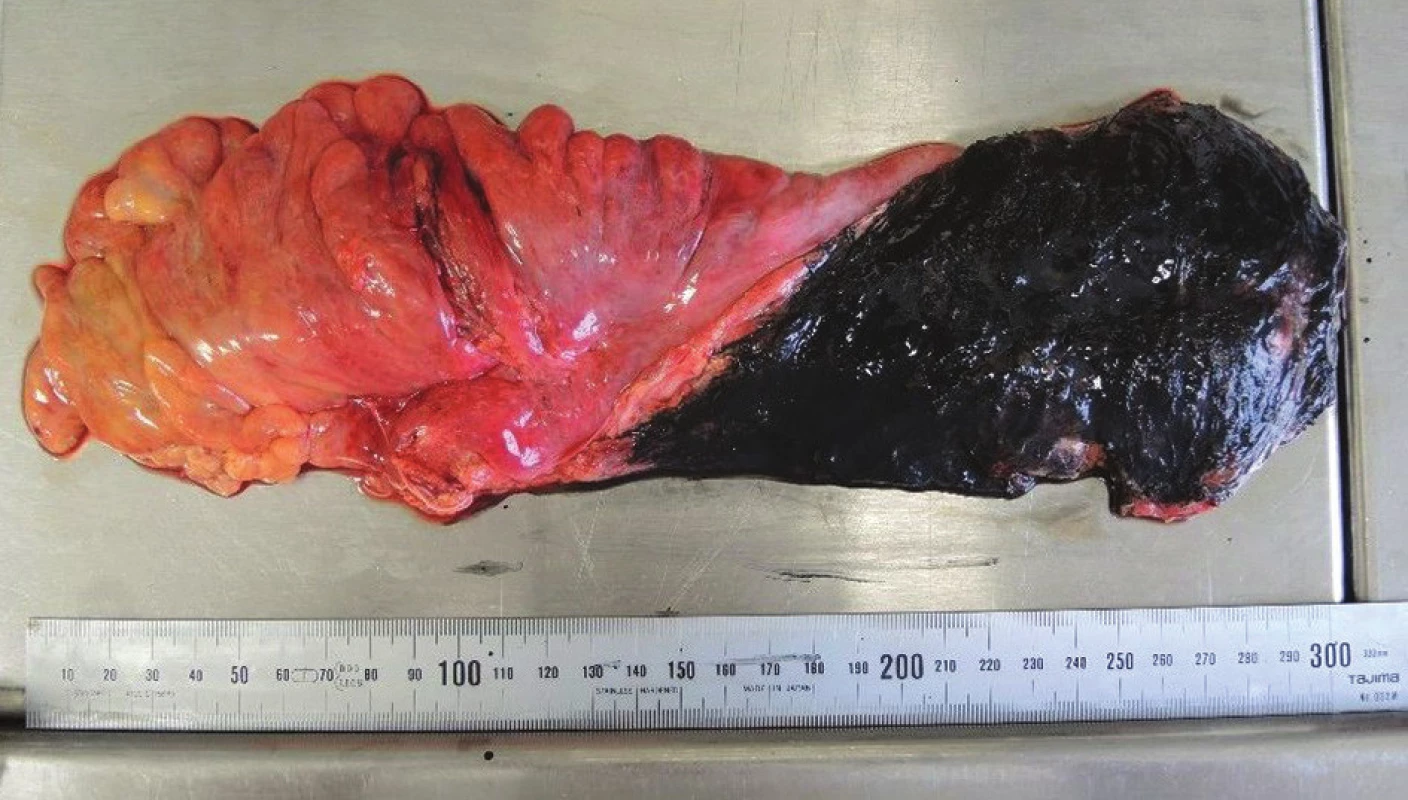 Fotografie resekátu s obarvením extraperitoneální části mezorektální tkáně tuší
Fig. 3: Photo of the resection specimen – inked extraperitoneal mesorectal surface