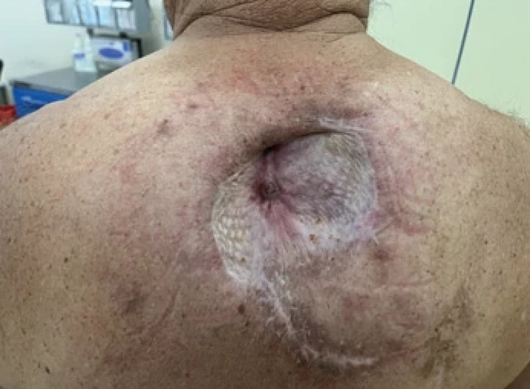Chronic defect of the back with central fi stulas, surrounded by healed split thickness skin graft and scars from previous surgery.