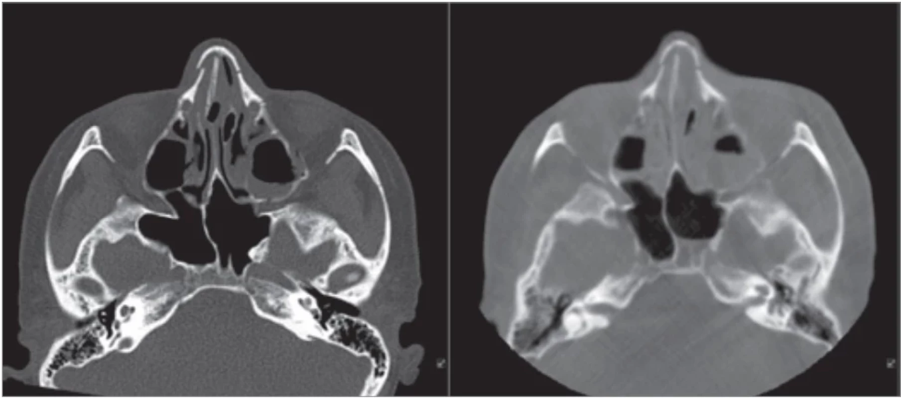Nasal bones on the TraumaSCAN (left); nasal bones after closed reduction on the intraoperative cone beam computed tomography (right).