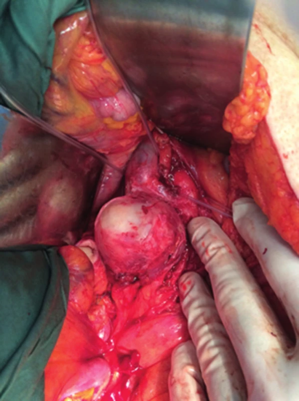 Primární tumor adherující k VCI
Fig. 2: Primary tumour adhering to IVC