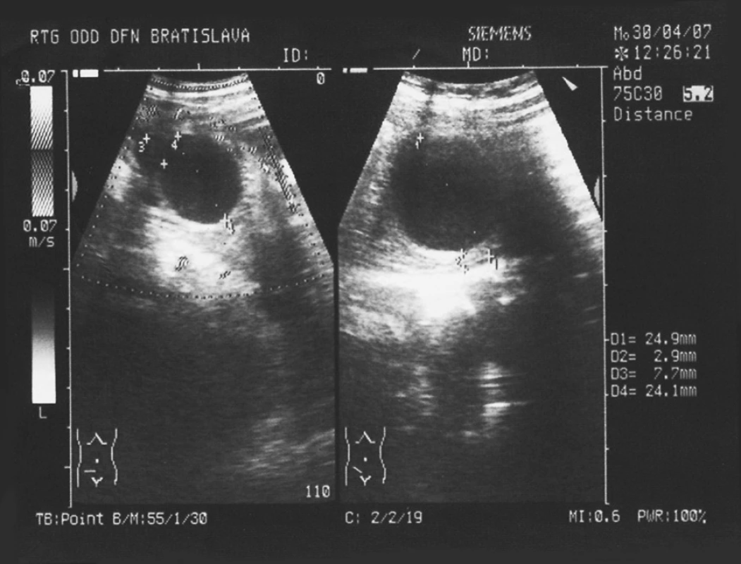 USG obraz cystického útvaru v pravom podbrušku. Signifikantná hrúbka steny útvaru 2,9 mm
Fig. 2. Ultrasonographic view of a cystic formation in the right hypogastrium. A significant wall width of 2.9 mm
