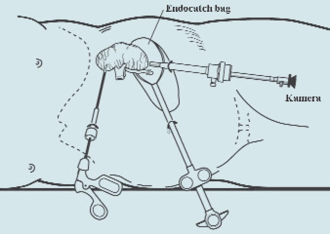 Vložení preparátu do sáčku (Endocatch bag<sup>®</sup>).