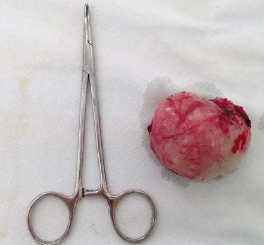 Excidovaný leiomyom močového měchýře – preparát
Fig. 4. Excised tumor – specimen