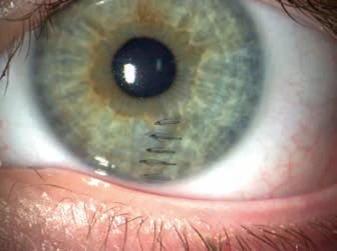 Sklerokorneální perforující poranění ošetřené suturou. Perforating sclerocorneal injury treated with sutures.