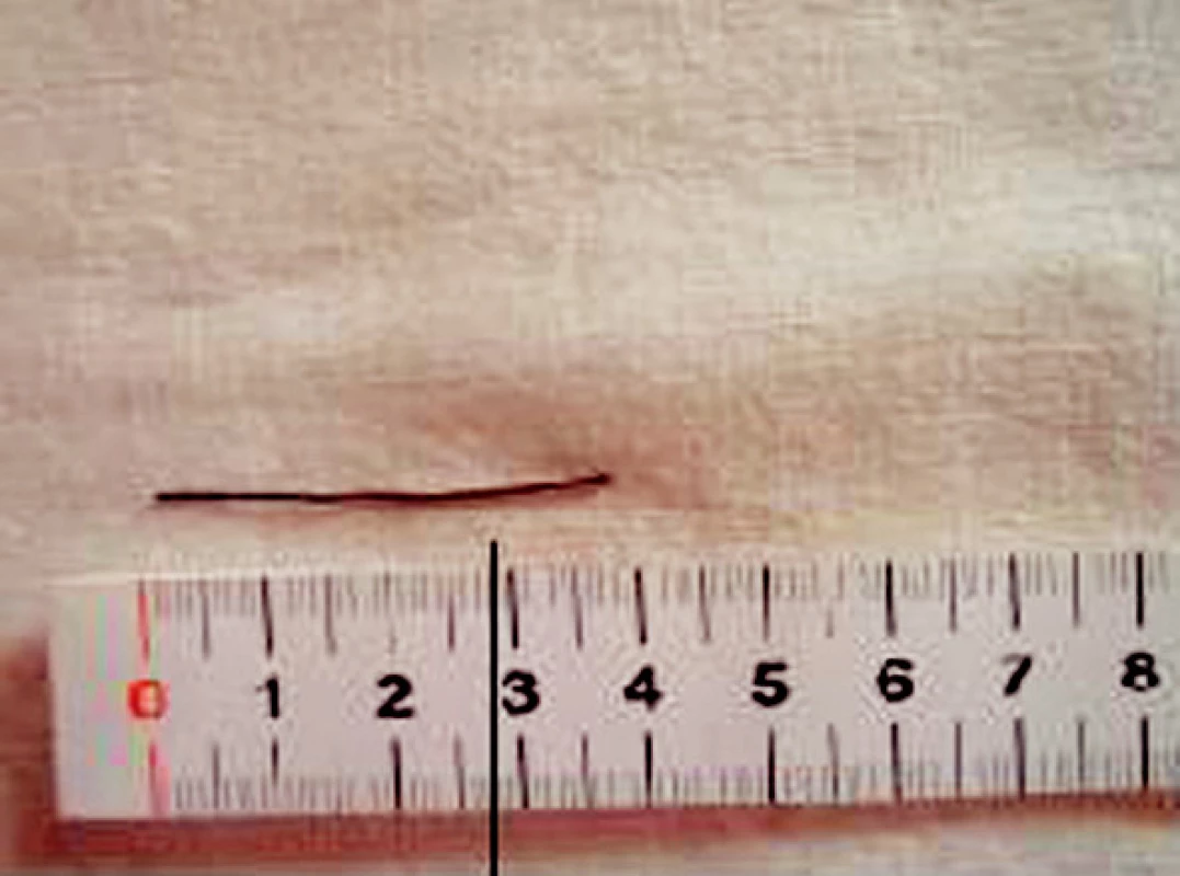 Exstirpovaná část zavaděče
Fig. 8. Extracted part of the probe