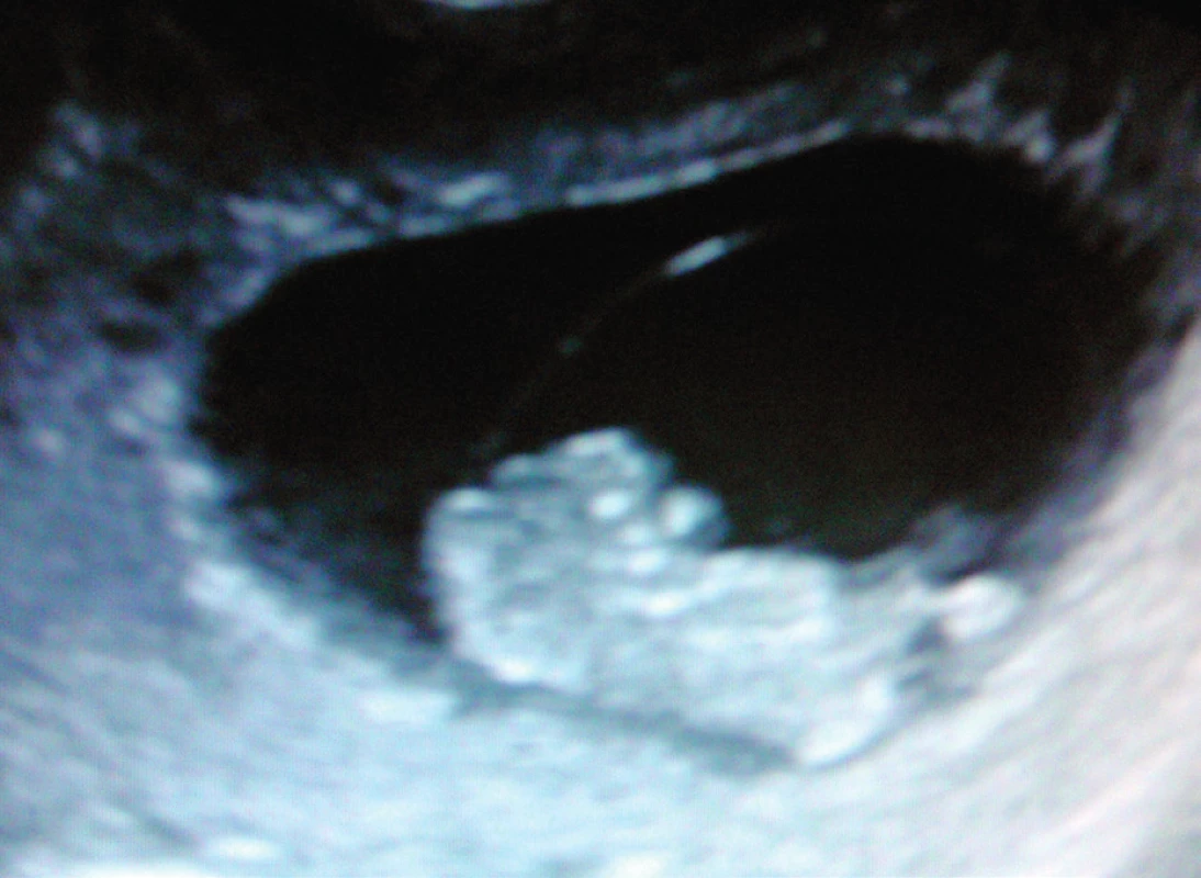 Anencefalus