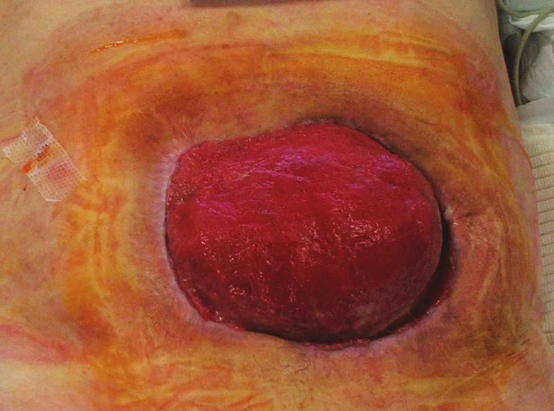 Situace 3 týdny po rekonstrukční operaci GIT s ponechaným laparostomatem (pacient č. 9)
Fig. 5 The same patient 3 weeks after his GIT reconstruction procedure with laparostomy (patient No 9)