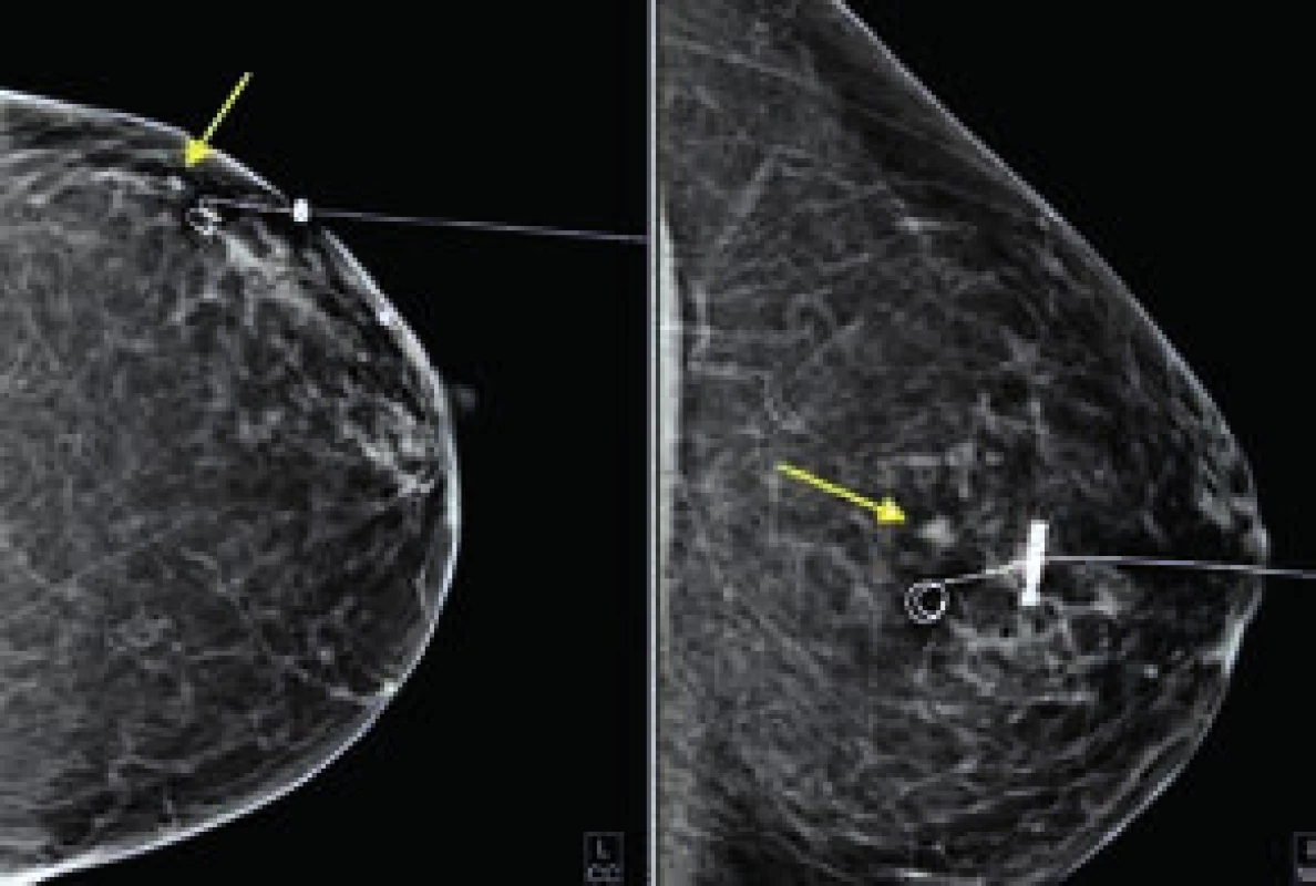 Mamogram s vodičem v CC a ML projekci.
Malý tumor označen šipkou