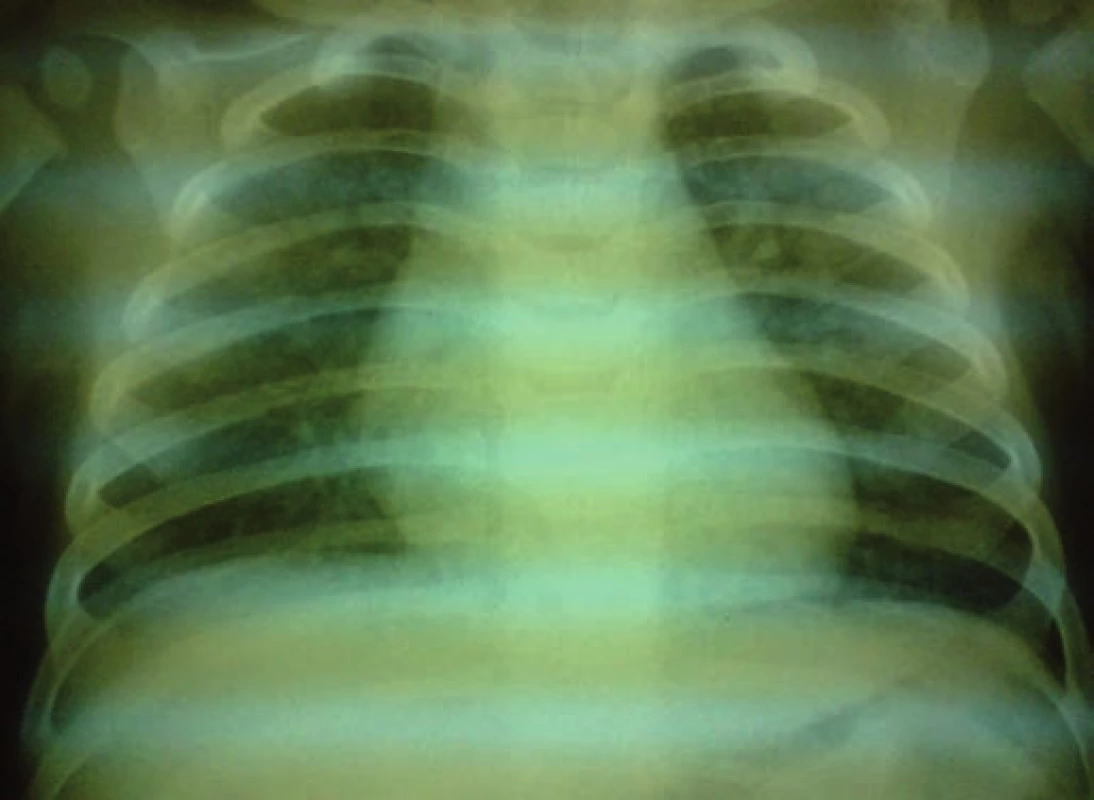 RTG hrudníka: diskrétne splývavé polosýte tiene voštinovitej kresby obojstranne v horných pľucnych poliach – atypická pneumónia.
Fig. 2. X-ray of the chest: discrete blended half-tone shades of the honeycomb design bilaterally in upper pulmonary fields – atypical pneumonia.