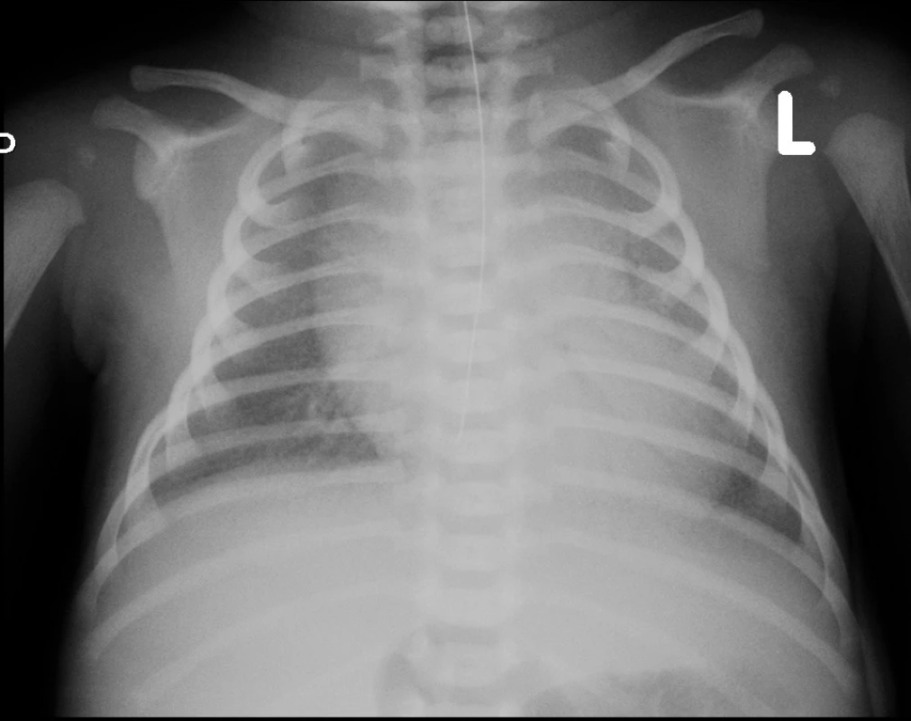 Rtg hrudníku – zahájení UPV, před podáním surfaktantu.
Fig. 1. Chest X-ray – 1st day of life, before surfactant administration.