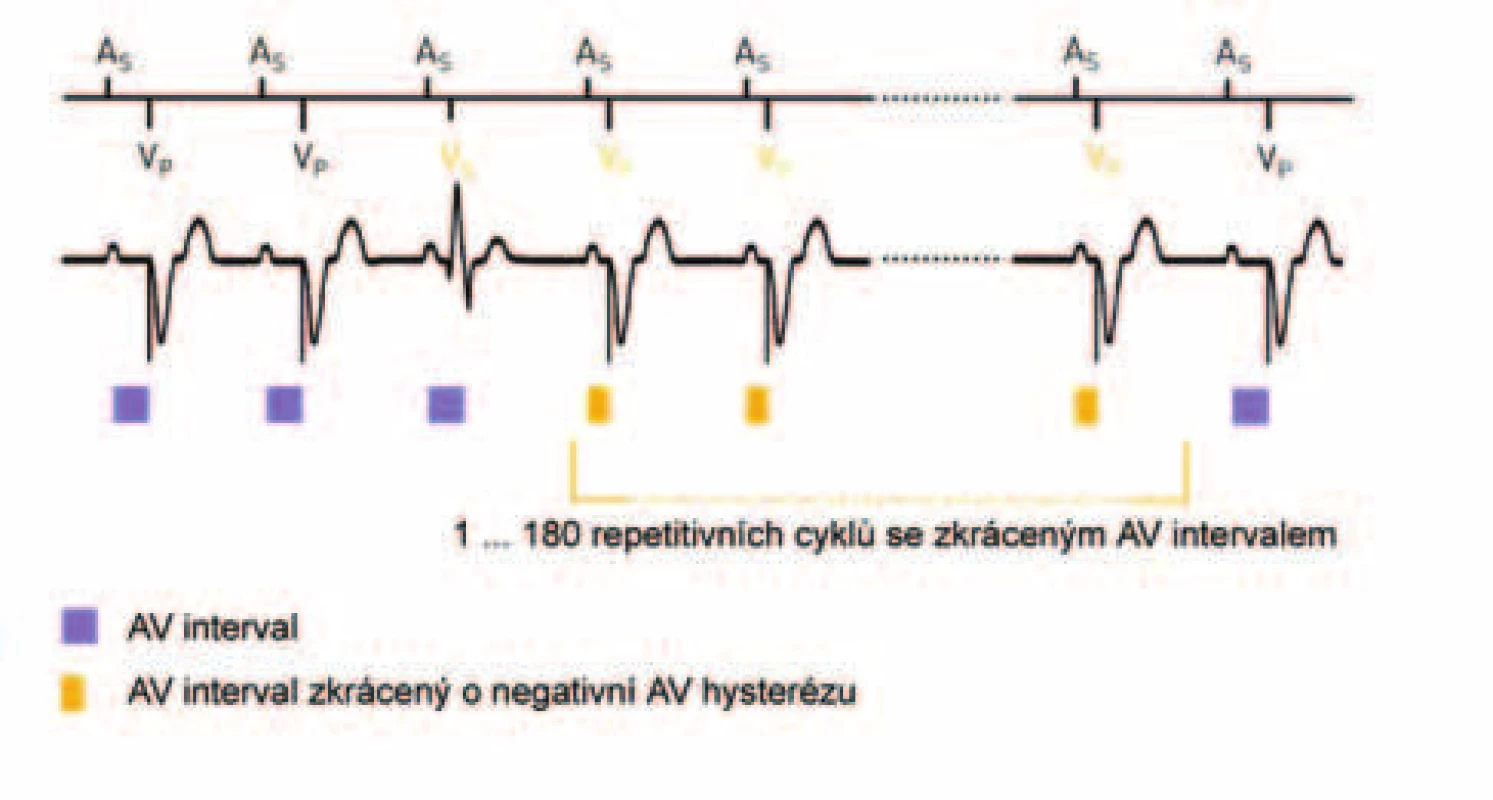 Negativní AV-hystereze. Detekce spontánního síňokomorového vedení (spontánní komorové depolarizace uvnitř AV-intervalu) vede ke zkrácení AV-delay. Po programovaném počtu intervalů s trvající komorovou stimulací je AV-delay prodloužen na původní hodnotu. (zdroj: Biotronik Philos II. Výukový materiál)