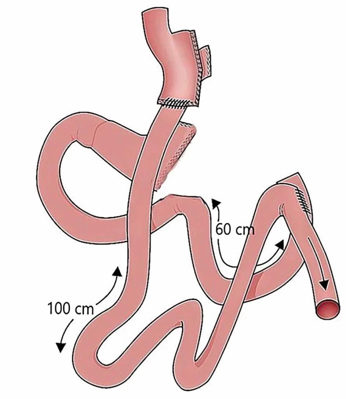 RYGB po SE    Fig. 3: RYGB after SE