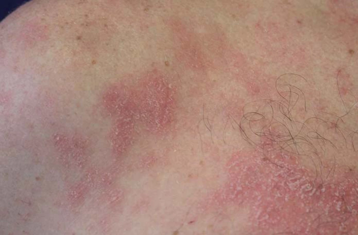Psoriaziformní dermatitida.
Fig. 9. Psoriasiform dermatitis.