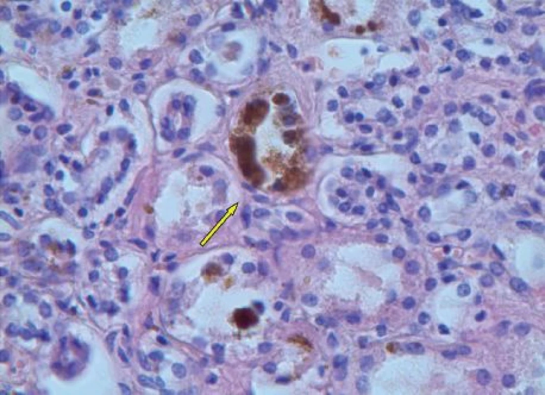 Ledvinný kanálek s hemosiderinovými depozity, hematoxylineosin