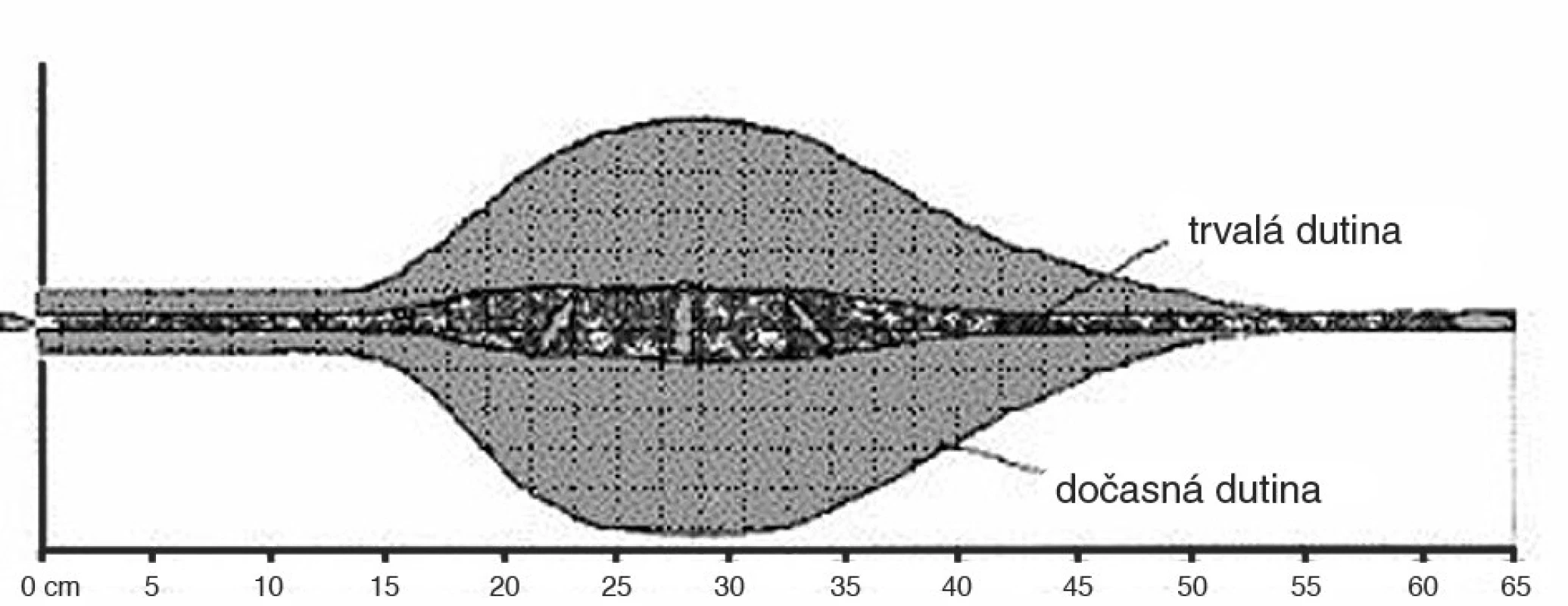 Profil rány střely 7,62 x 51 mm. FMC
Fig. 4. Wound profile of bullet Cal. 7.62 x 51 FMC