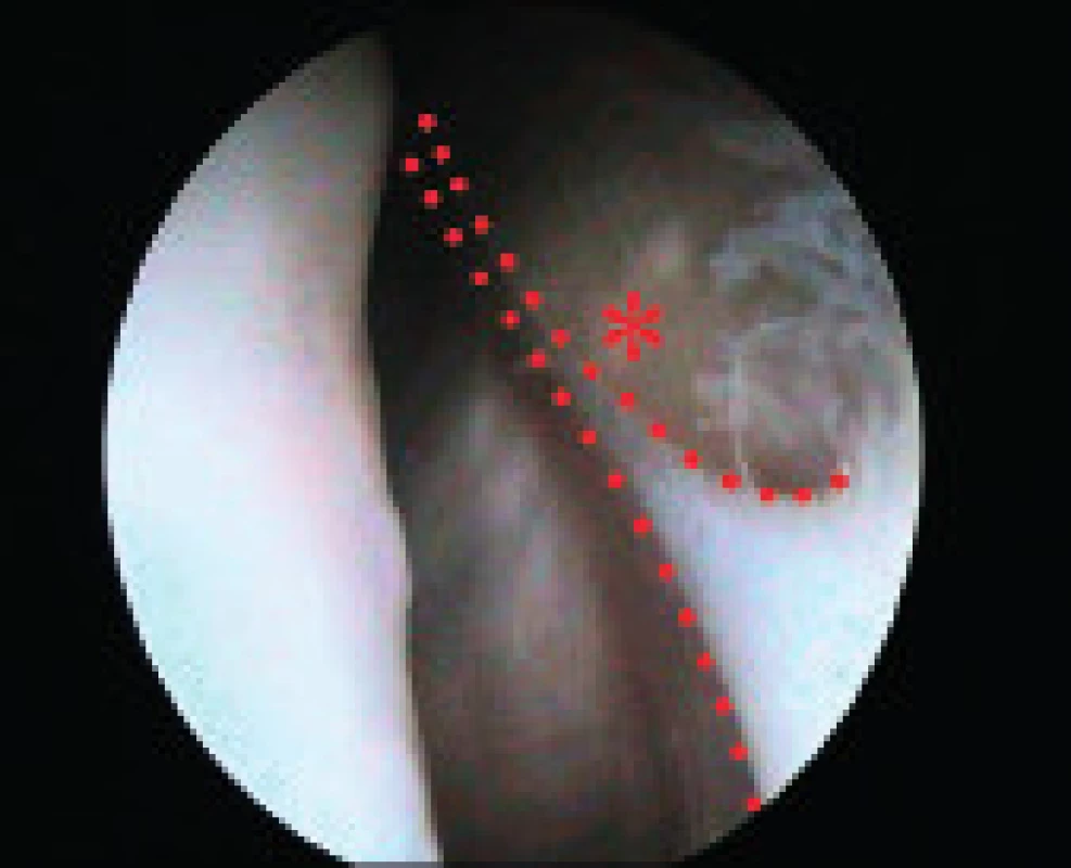 Artroskopický pohled na napjatou mediopatelární pliku – kontury pliky naznačeny.
Fig. 4. Arthroscopic view of the mediopatellar plica.