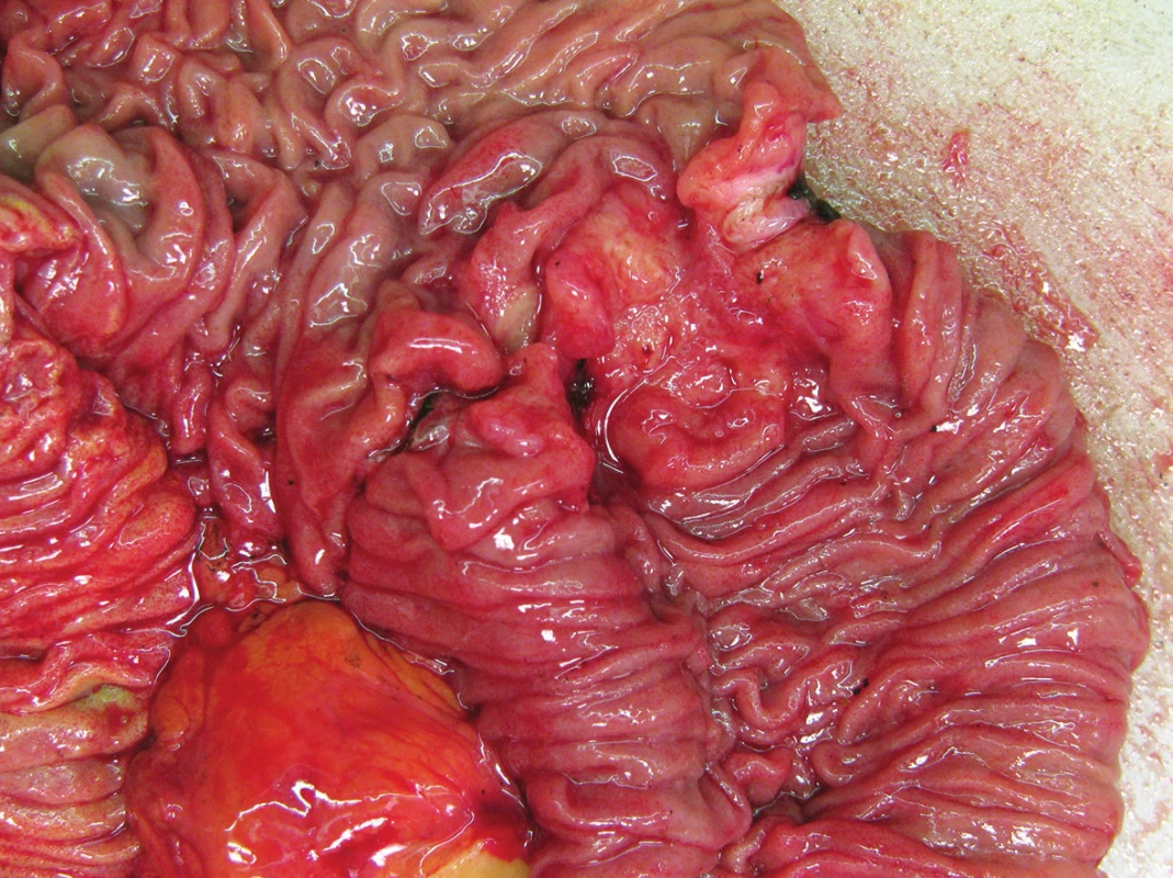 Adenokarcinom duodena
Fig. 1: Adenocarcinoma of the duodenum