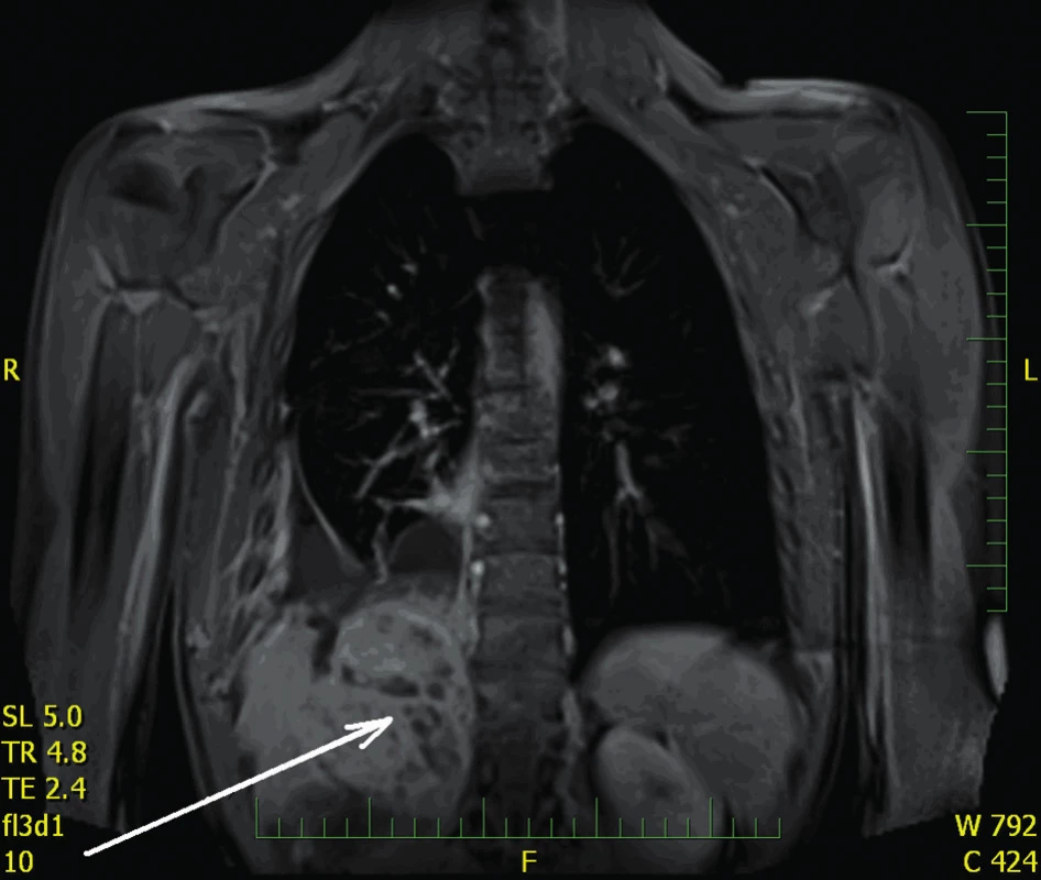 Tumor, kazuistika 4
Fig. 6: Tumor, case report 4