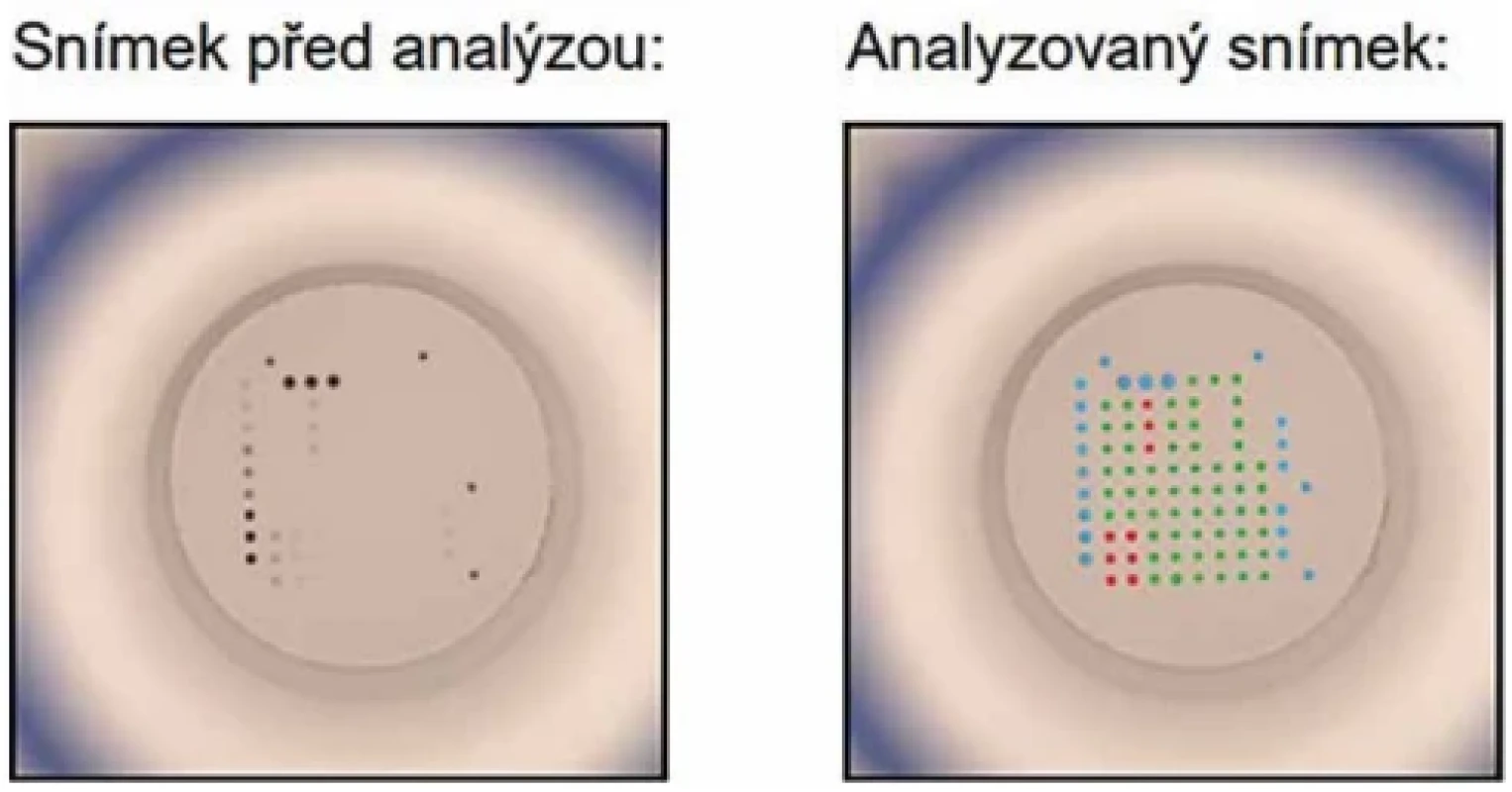 Analýza vzorku likvoru pacienta 4363 na Microblot-Array Borrelia IgG; pozitivní antigen VIsE a p17 (foto B. Macúchová, vlastní fotografie, Laboratoře AGEL a.s.) Figure 3. Analysis of a  cerebrospinal fluid sample from patient 4363 using the Microblot-Array Borrelia IgG; positive for VlsE and p17 antigens (photo by B. Macúchová, original photograph, AGEL Laboratories, Inc.)