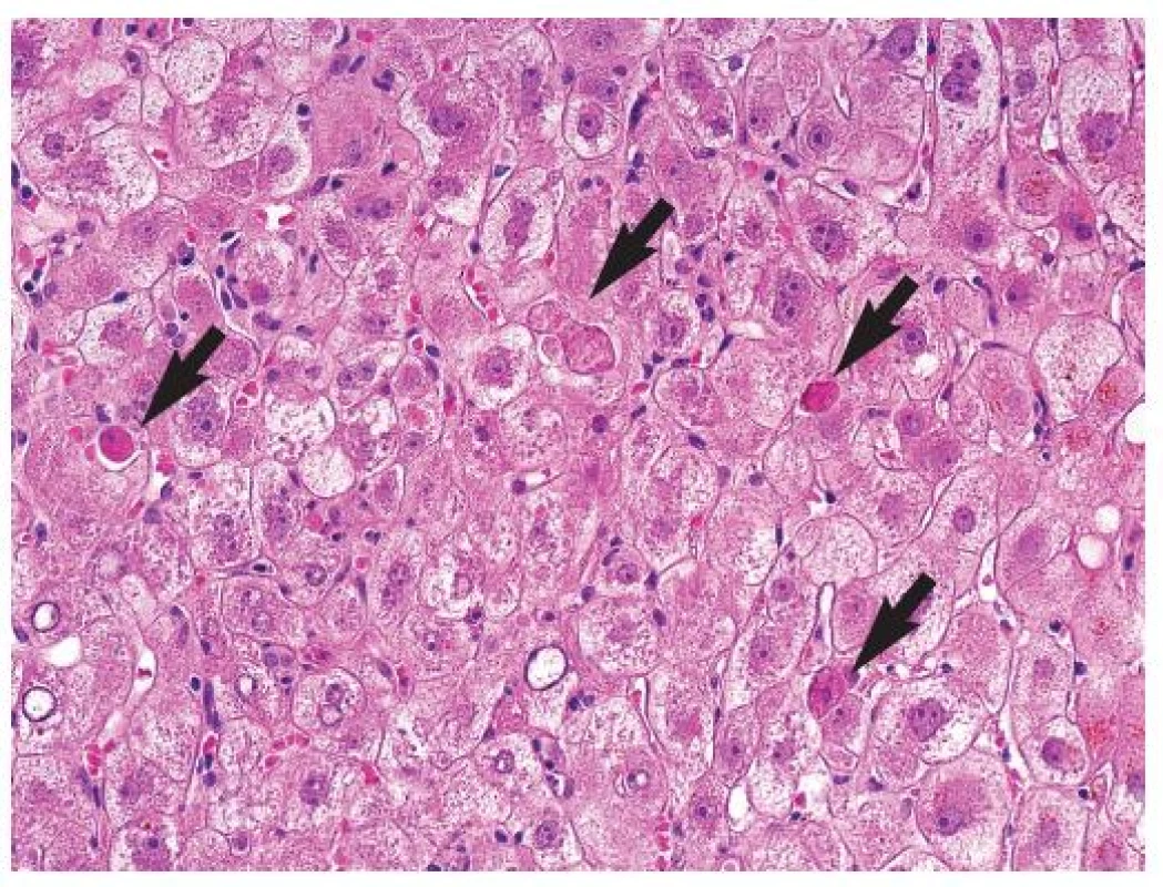 Cytolytická forma fibrocholestatické hepatitidy s četnými acidofilními tělísky (šipky), s cholestatickým zduřením hepatocytů. HE, objektiv 40x.