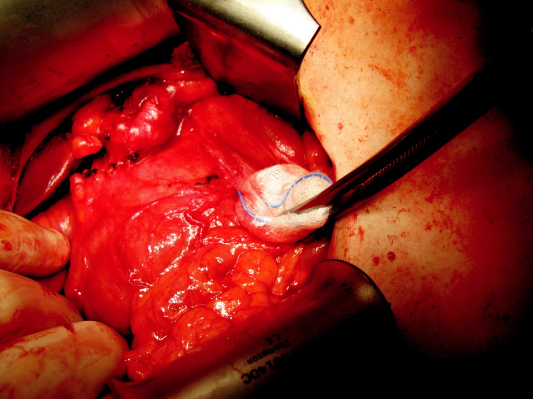 Infiltrát žlučníku, duodena a colon transversum
Fig. 6. Infiltration of the gallbladder, duodenum and colon transversum