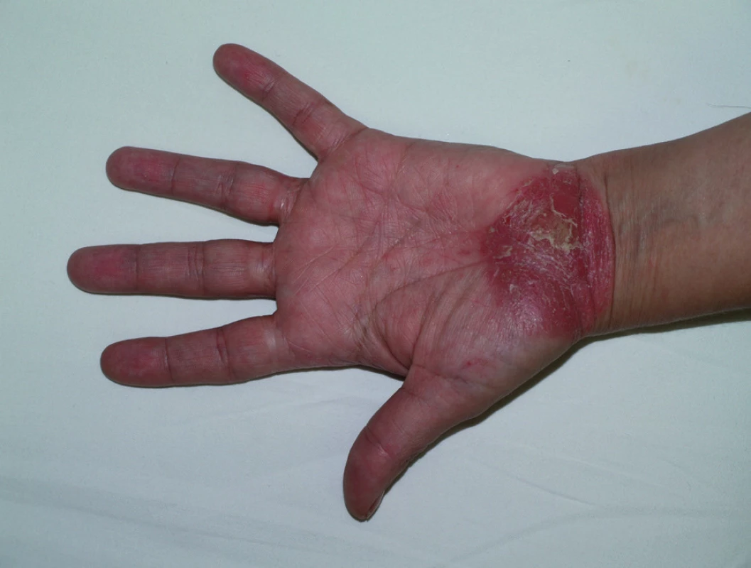 Psoriatické ložisko na dlani při léčbě etanerceptem.