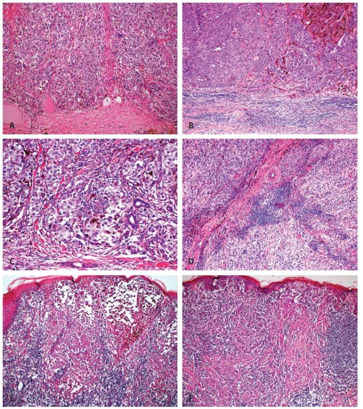 Hodnocení zánětlivé celulizace u maligního melanomu dle Clarka: A. Žádná zánětlivá celulizace (kategorie „absent“) (zvětšení 100 x). B. Zánětlivá celulizace v přilehlém stromatu, bez infiltrace nádoru (kategorie „absent“) (zvětšení 100 x). C. Fokální mírná zánětlivá celulizace (kategorie „non-brisk“) (zvětšení 200 x). D. Fokální výraznější zánětlivá celulizace (kategorie „non-brisk“) (zvětšení 100 x). E. Splývající zánětlivá celulizace zejména v periferii nádoru (kategorie „periferní brisk“) (zvětšení 40 x). F. Splývající zánětlivá celulizace ve většině oblastí nádoru (kategorie „difúzní brisk“) (zvětšení 40 x).