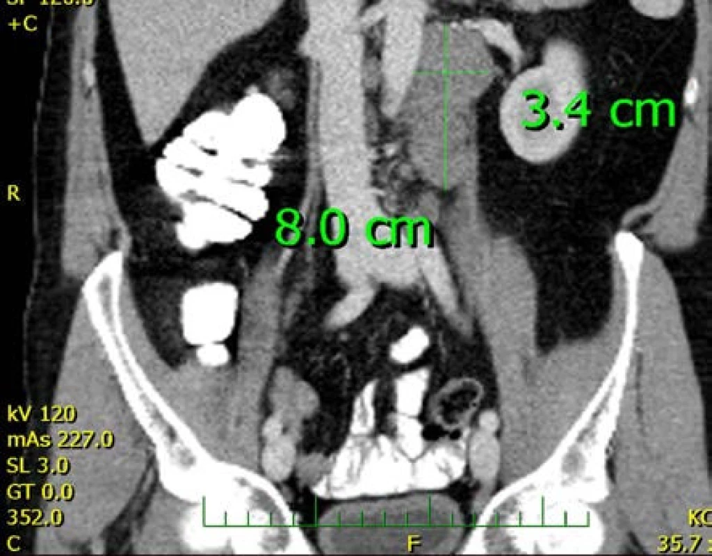 CT snímek s patrným paketem uzlin levého retroperitonea
Fig. 3. CT scan showing left retroperitoneal lymphadenopathy
