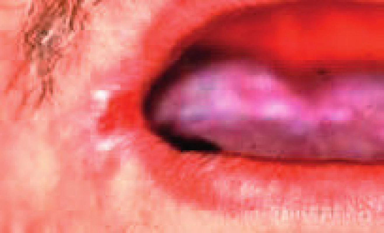 Škvrnitá leukoplakia ústneho kútiku, prechádza do erytroplakie (Ďurovič)