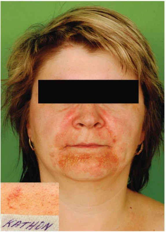 Eczema contactum – Kathon CG (šampony a další)
Epikutánní test – alergická reakce na Kathon CG