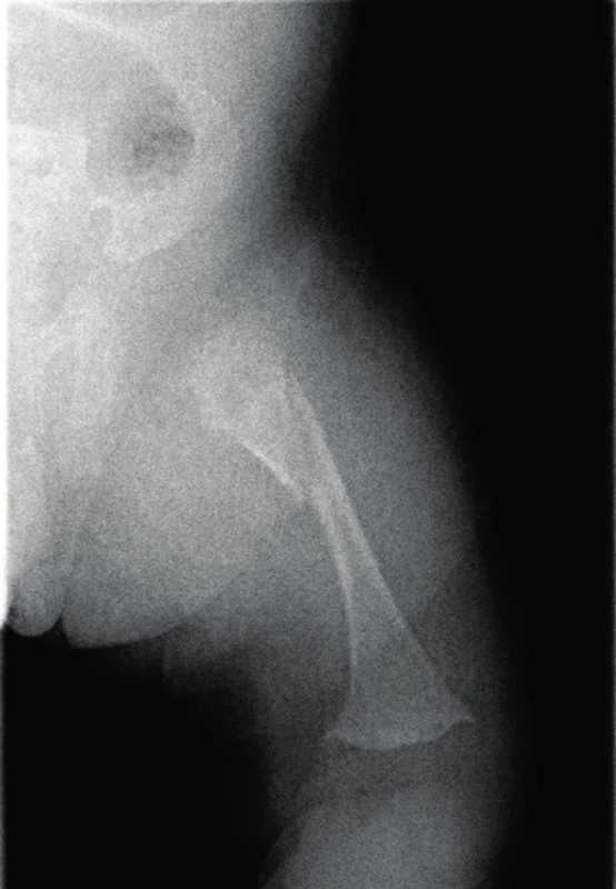 Fraktura pravého femuru jako následek metabolického kostního onemocnění při nezralosti.
Fig. 2. Fracture of the right femur as a result of metabolic bone disease of prematurity.