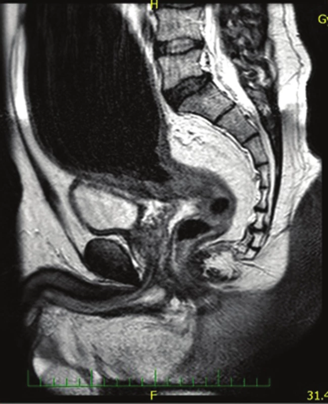 Magnetická rezonance u pacienta 1 s obrazem rektální formy H. ch.
Fig. 1: Magnetic resonance study showing a rectal form of HD in the first patient