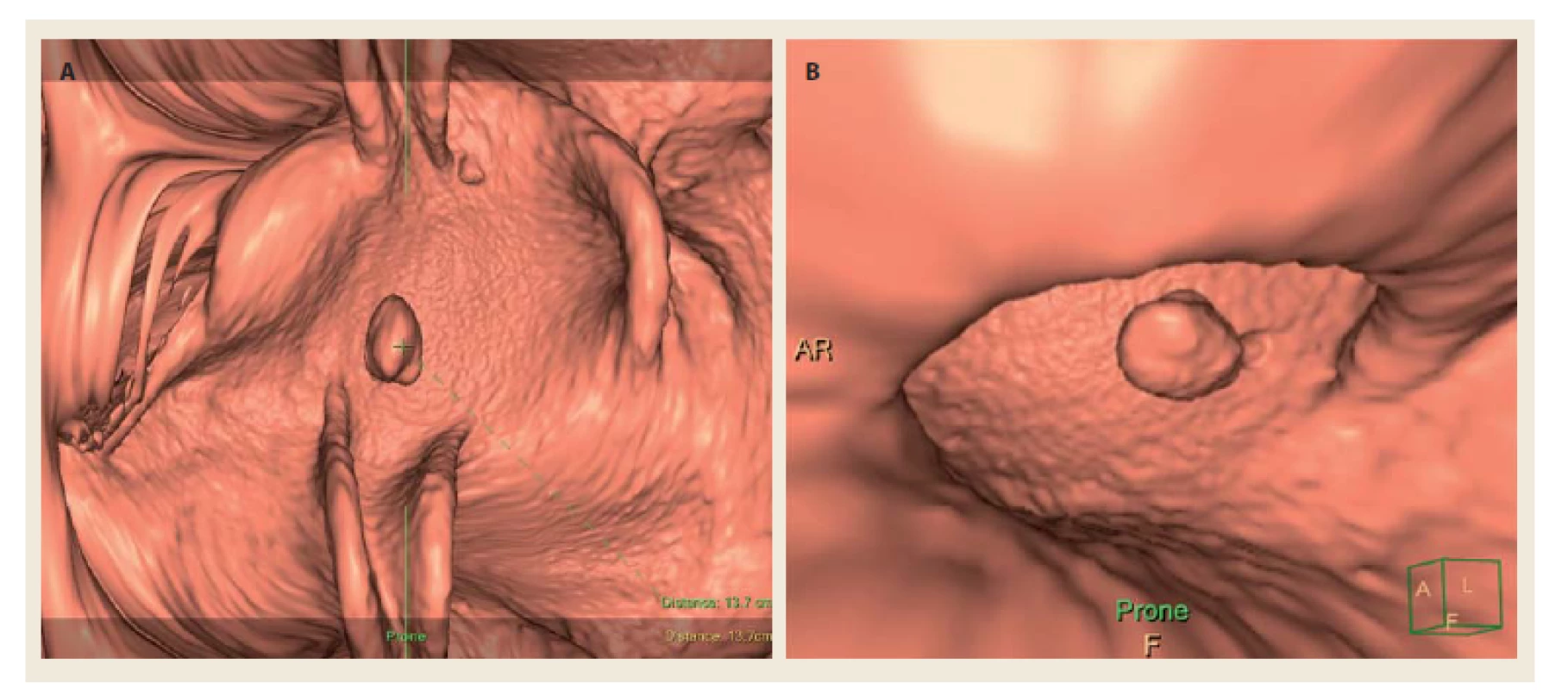 Stopkatý polyp rekta na CTC – trojrozměrné zobrazení (stejný polyp jako na obr. 1).
Fig. 2. Pedunculated rectal polyp on CTC – three-dimensional imaging (same polyp as shown in Fig. 1).